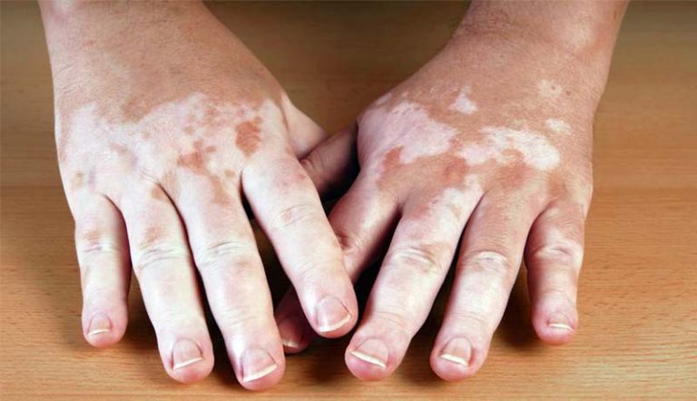 vitiligo en niños